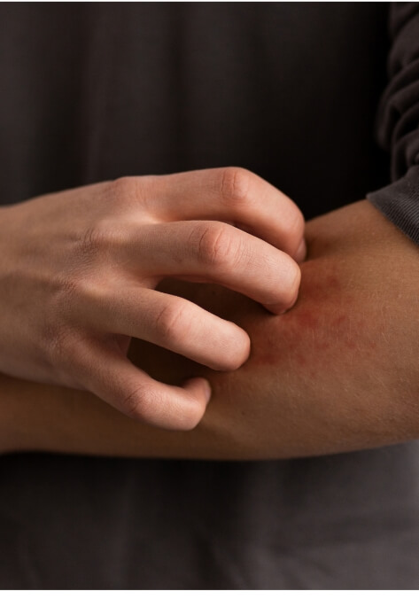 Mosquito Skin Bites