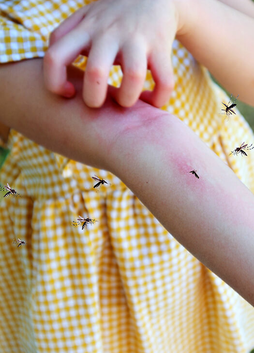 Little Girl has Skin Rash Allergy Itchy Arm from Mosquito Bite