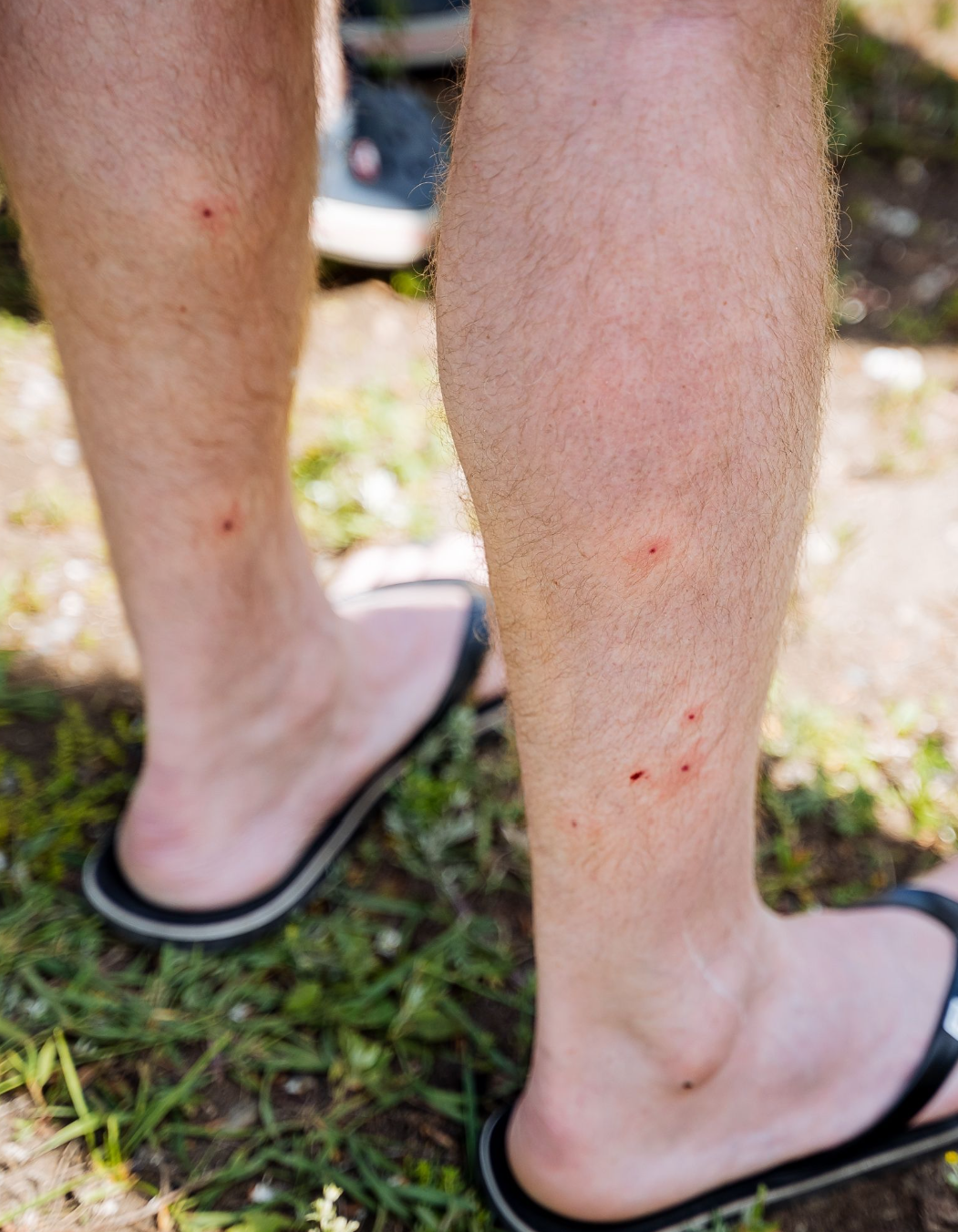 man standing outside with bug bites on legs