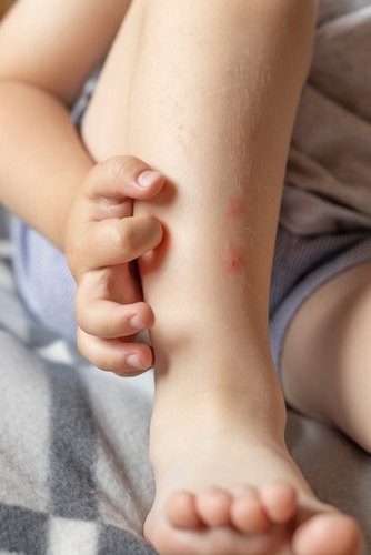 mosquito bites on leg