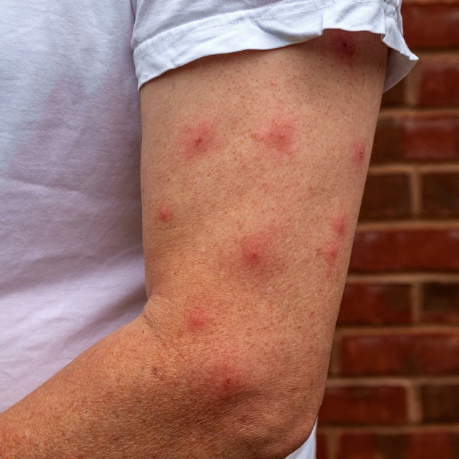 Mosquito Bites during the day Mosquito Shield