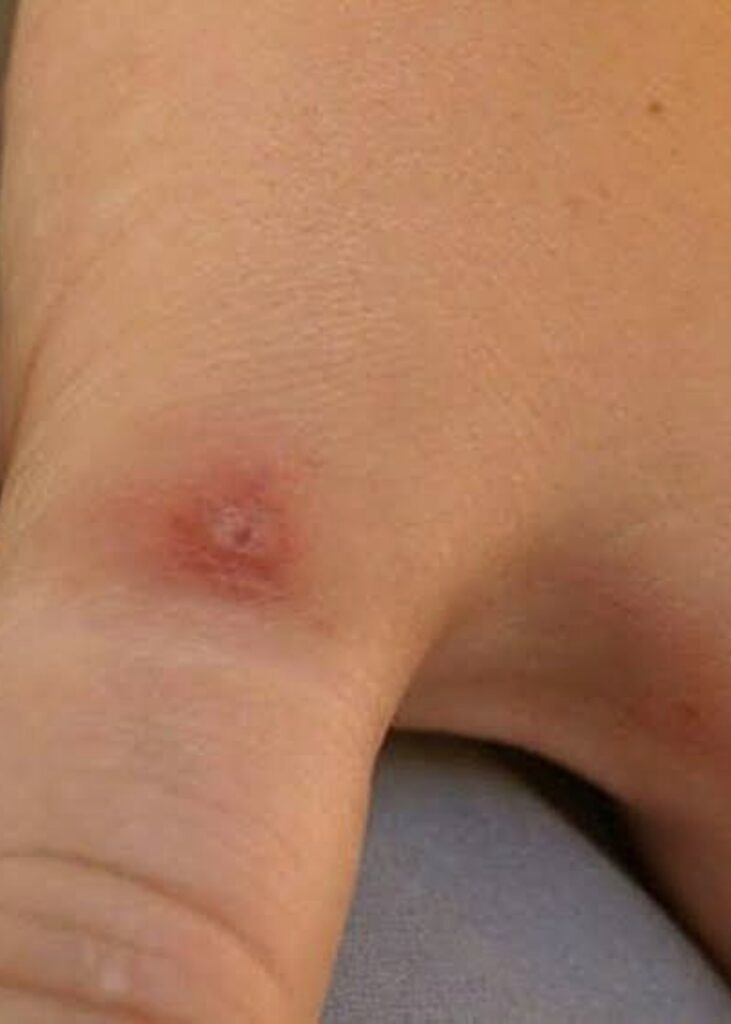 black widow spider bite